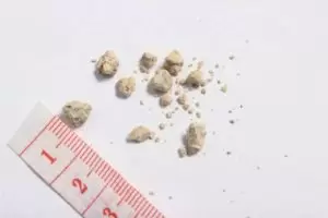 böbrek taşı neden olur