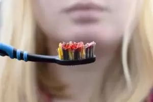 diş eti kanaması