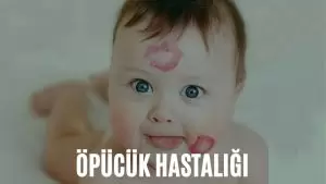 öpücük hastalığı